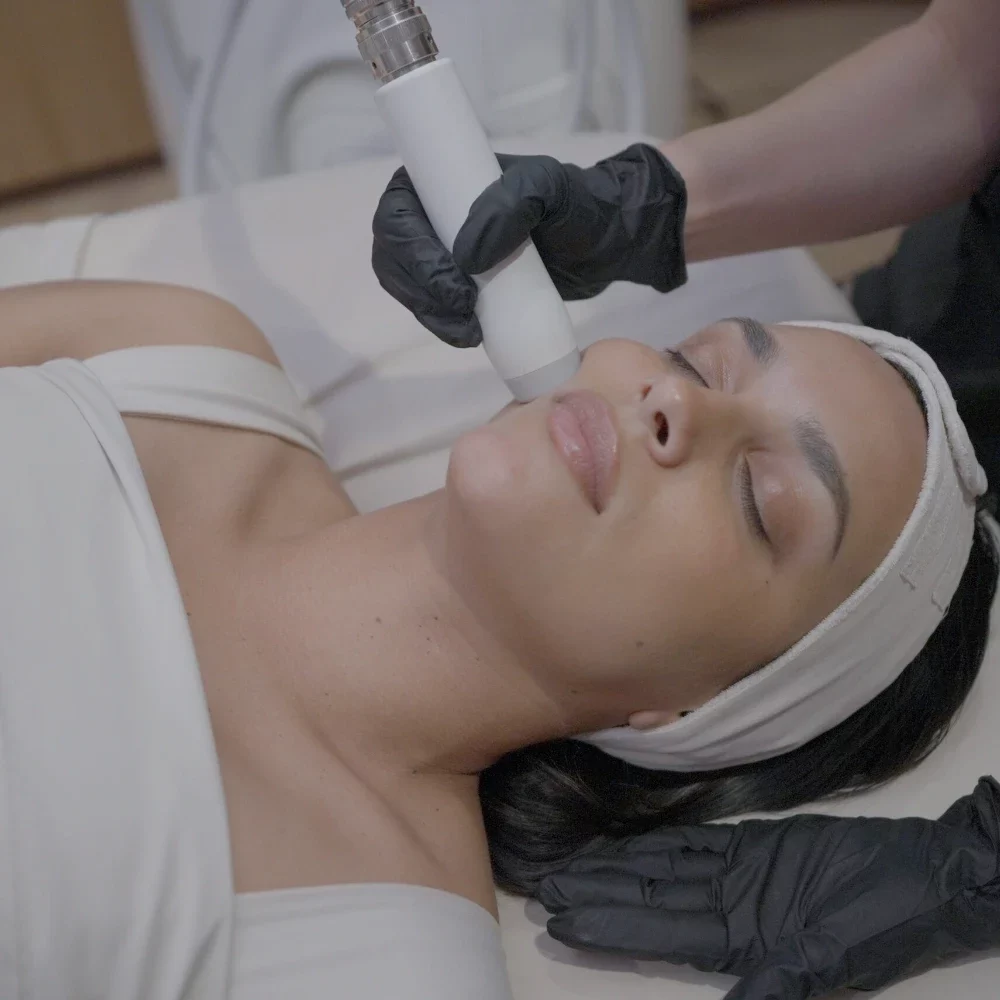 T-Shape 2 facial treatment on the cheek at iCRYO Clemson