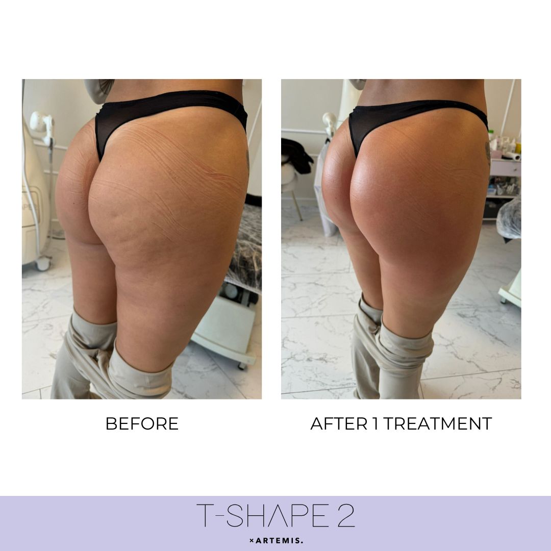 Body After 1 treatment